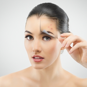 Try these acne solutions for summer