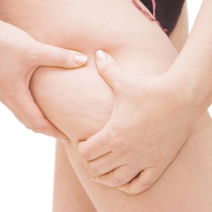 Will anything get rid of cellulite?